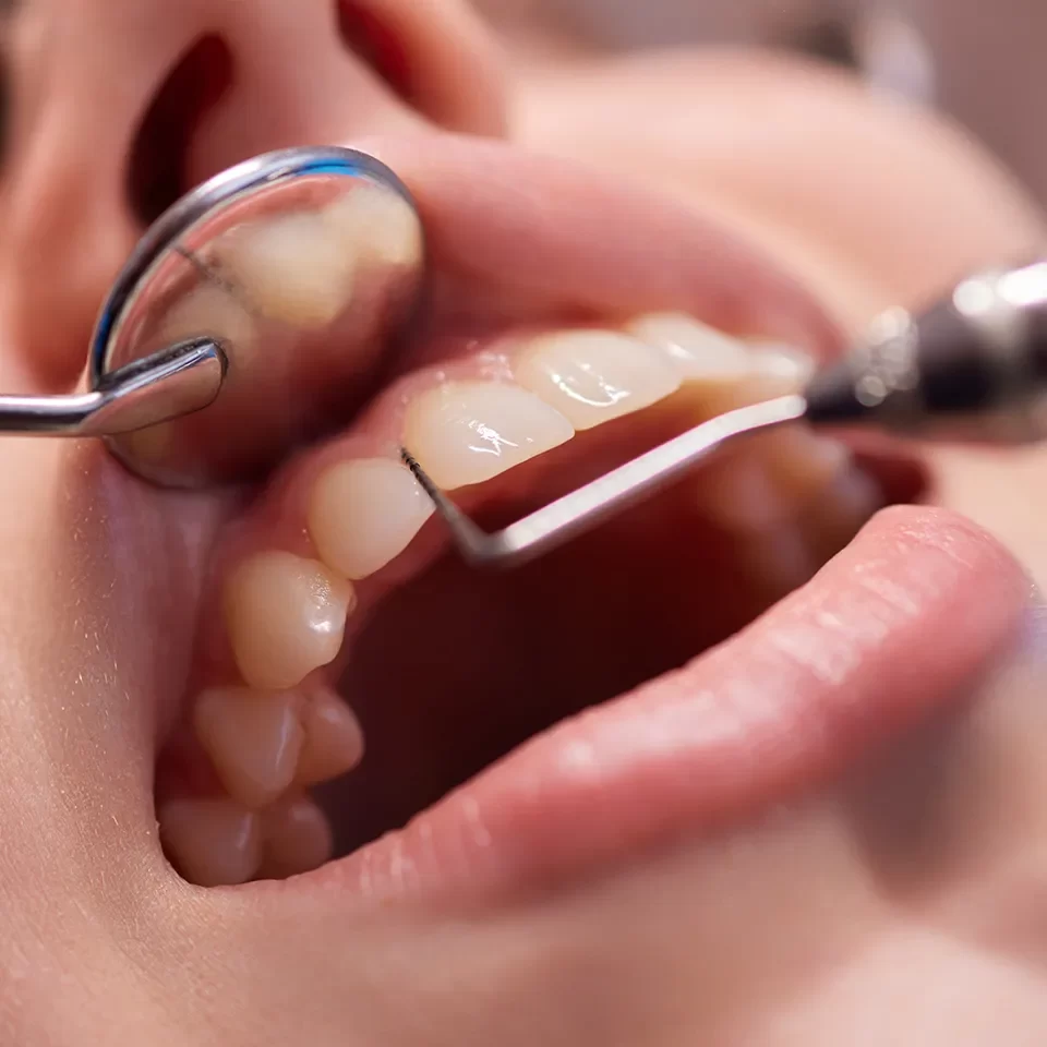 Dental Bonding in Markham