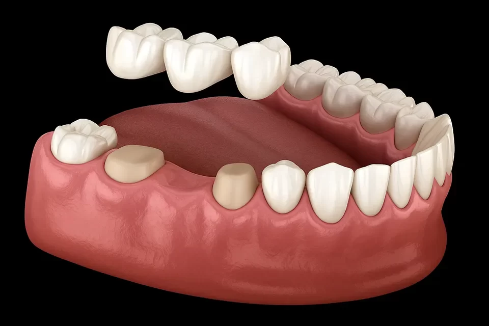 Dental Bridges in Markham
