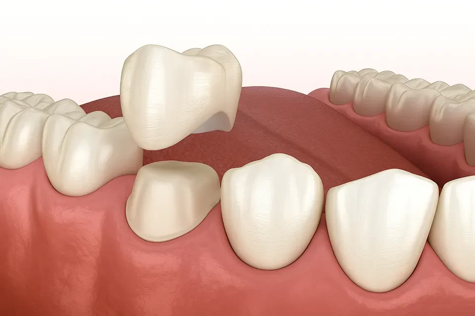 Dental Crowns in Markham
