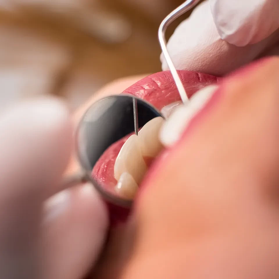 Dental Crowns in Markham