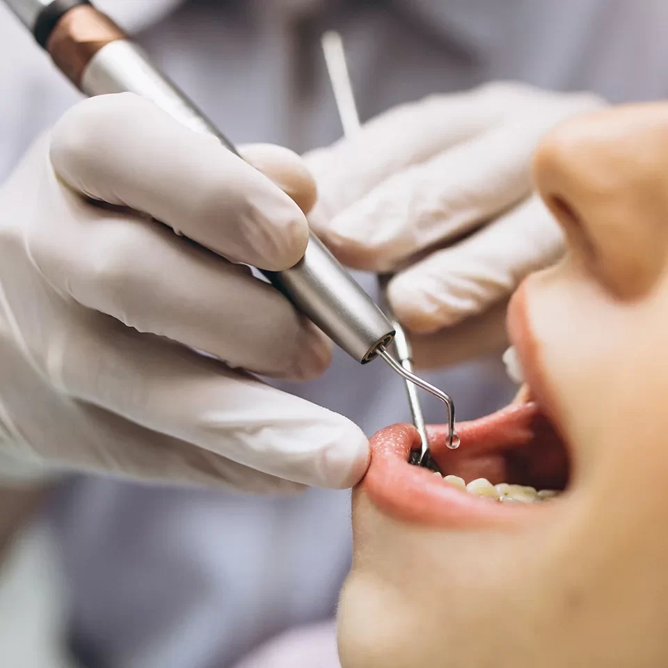 Dental Fillings in Markham