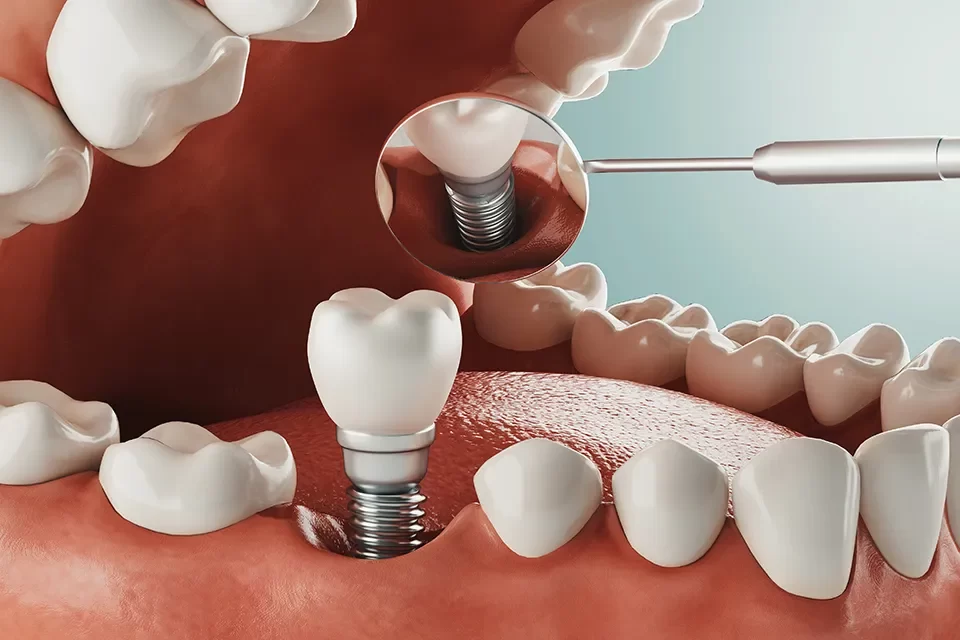 Dental Implants in Markham