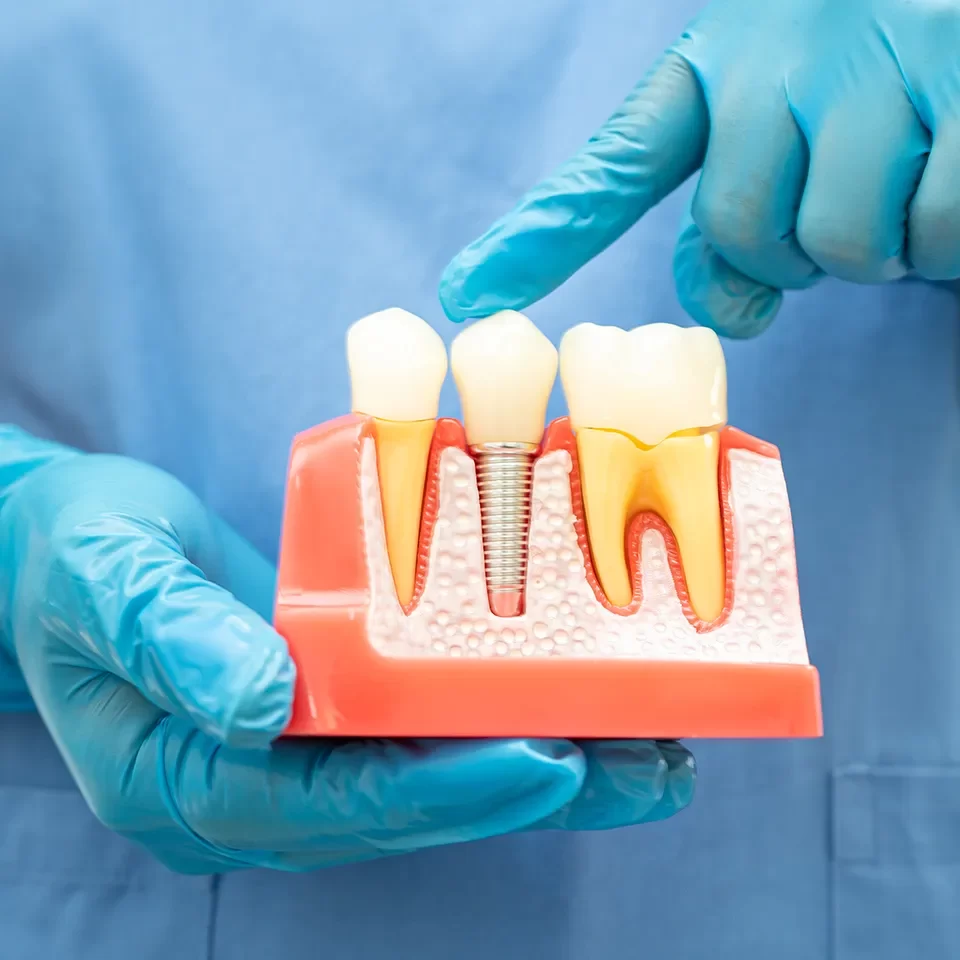 Dental Implants in Markham