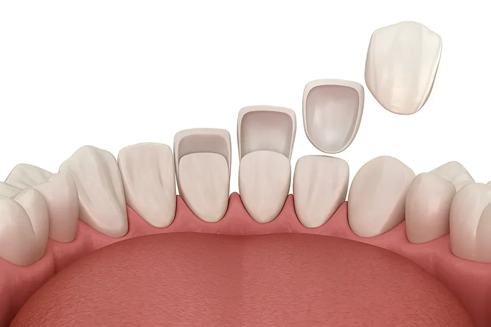 Dental Veneers in Markham