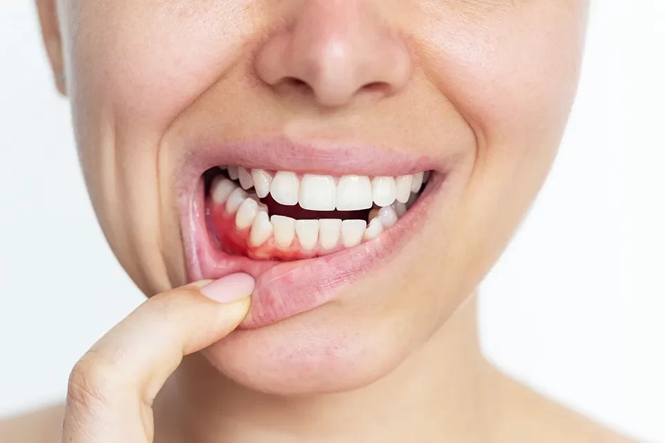 Gum Disease Treatment in Markham