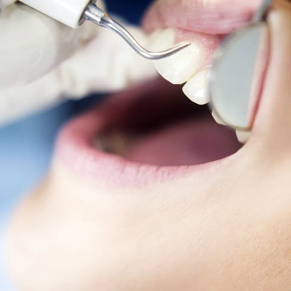 Gum Disease Treatment in Markham