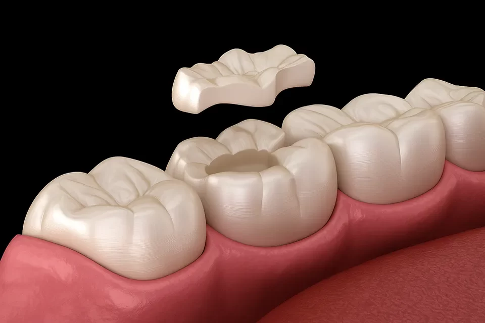Inlays & Onlays in Markham