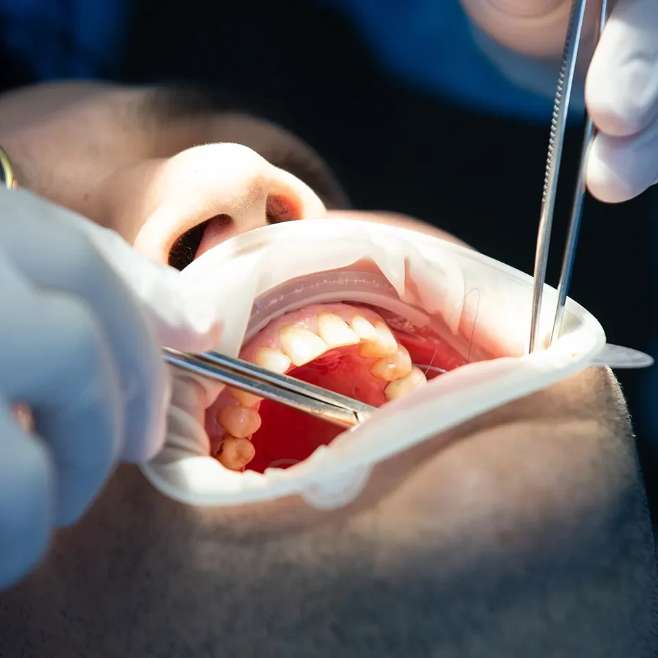 Root Canal Therapy in Markham