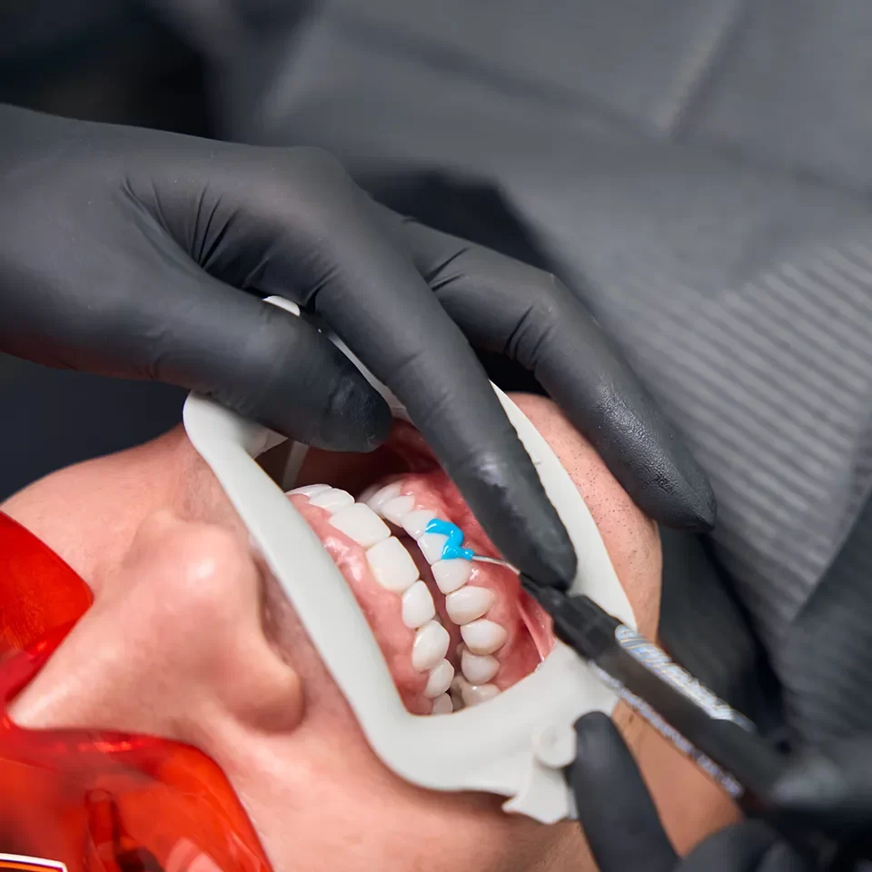 Smile Makeovers in Markham