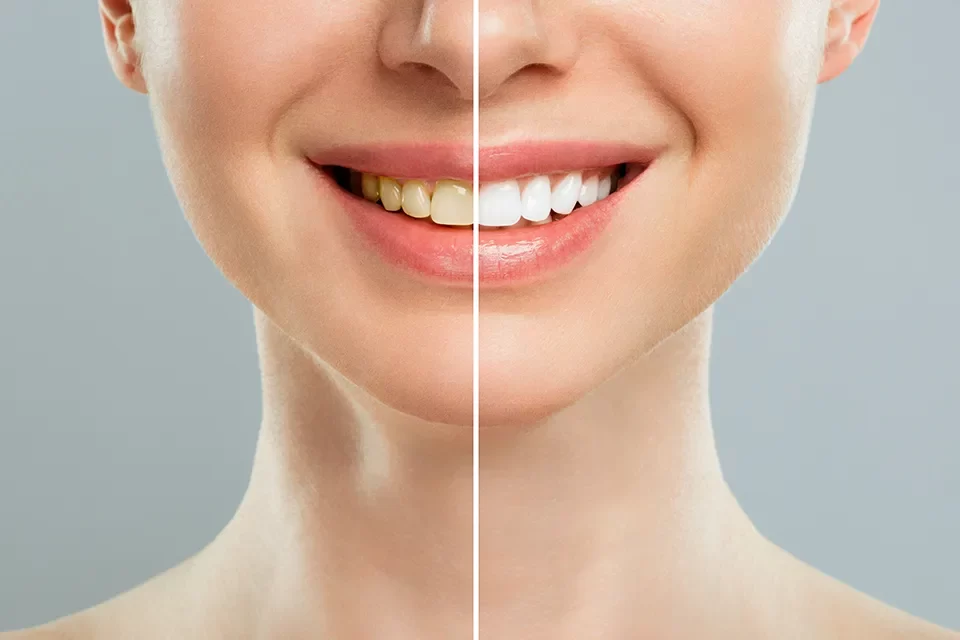 Teeth Whitening in Markham