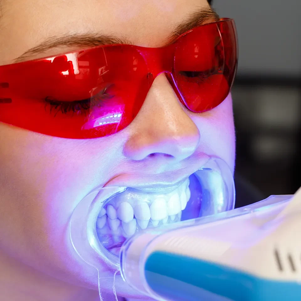 Teeth Whitening in Markham