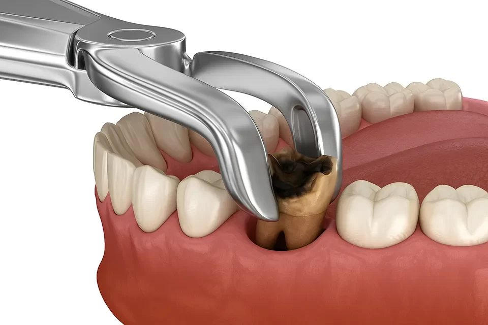 Tooth Extractions in Markham